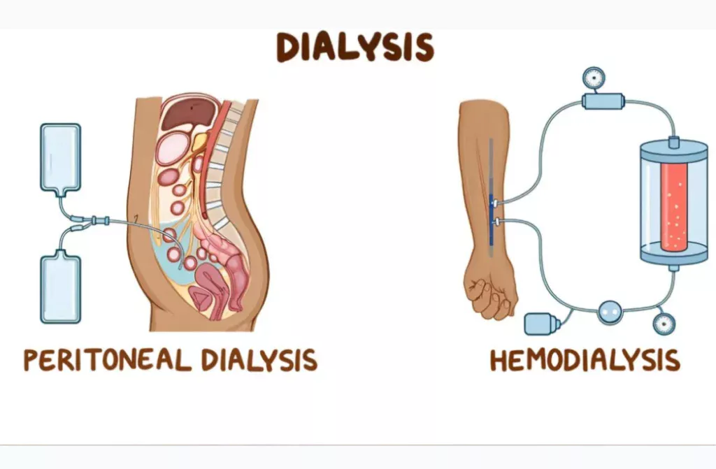 Hemodialysis vs Peritoneal Dialysis – Which Is Safer?
