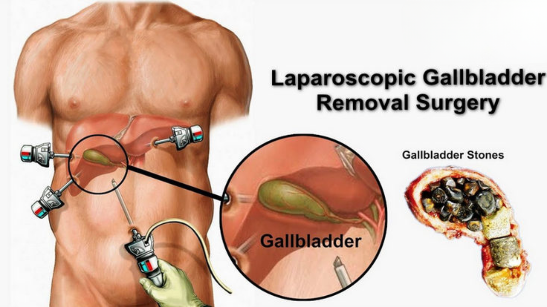 Small Cuts, Big Relief – The Modern Way to Treat Gallbladder Stones Safely and Effectively