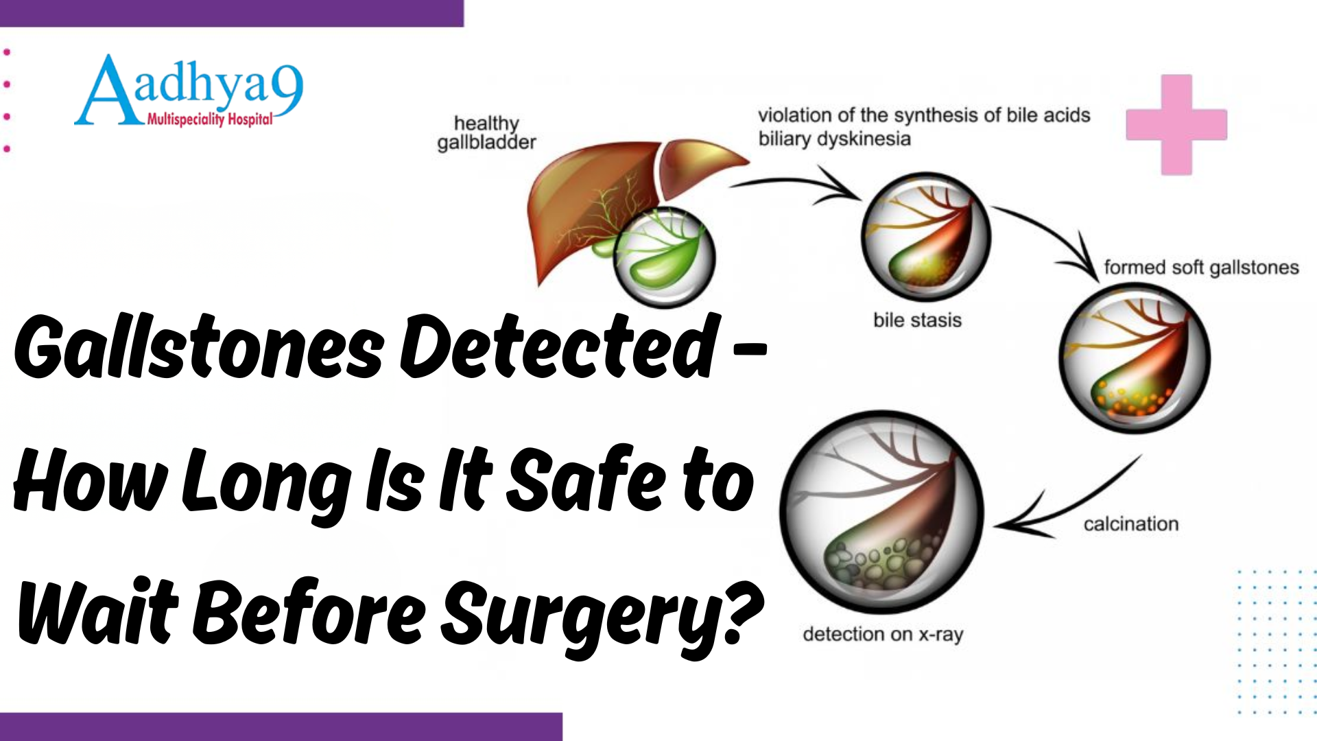 Gallstones Detected – How Long Is It Safe to Wait Before Surgery?